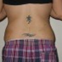 1 week after smart lipo - back